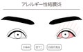 Medical Clipart, Line Drawing Illustration of Eye Disease and Allergic conjunctivitis - Translation: Allergic conjunctivitis,