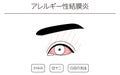 Medical Clipart, Line Drawing Illustration of Eye Disease and Allergic conjunctivitis - Translation: Allergic conjunctivitis,