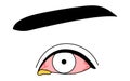 Medical Clipart, Line Drawing Illustration of Eye Disease and Bacterial conjunctivitis - Translation: Bacterial conjunctivitis,