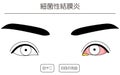 Medical Clipart, Line Drawing Illustration of Eye Disease and Bacterial conjunctivitis - Translation: Bacterial conjunctivitis,