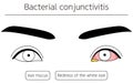 Medical Clipart, Line Drawing Illustration of Eye Disease and Bacterial conjunctivitis