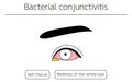 Medical Clipart, Line Drawing Illustration of Eye Disease and Bacterial conjunctivitis