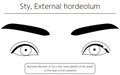 Medical Clipart, Line Drawing Illustration of Eye Disease and Sty, external hordeolum