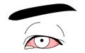 Medical Clipart, Line Drawing Illustration of Eye Disease and Viral conjunctivitis - Translation: Viral conjunctivitis, eye mucus