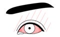 Medical Clipart, Line Drawing Illustration of Eye Disease and Viral conjunctivitis - Translation: Viral conjunctivitis, eye mucus