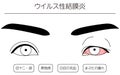 Medical Clipart, Line Drawing Illustration of Eye Disease and Viral conjunctivitis - Translation: Viral conjunctivitis, eye mucus