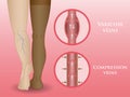 Medical compression hosiery Royalty Free Stock Photo