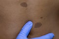 Medical dermatologist examines benign moles in African patient