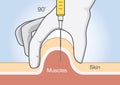 Doctor insert medications into the muscle tissue with injection needle.