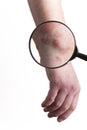 Medical Exam on Psoriasis Royalty Free Stock Photo