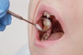 Medical examination of teeth using a mirror by a dentist. Caries, tooth damage