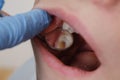 Medical examination of teeth using a mirror by a dentist. Caries, tooth damage.