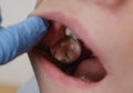 Medical examination of teeth using a mirror by a dentist. Caries, tooth damage.