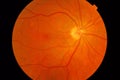 Medical fundus photo of macula Royalty Free Stock Photo