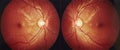 Medical fundus photo of macula