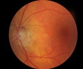 Medical fundus photo of macula Royalty Free Stock Photo