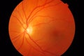 Medical fundus photo of macula