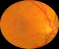 Medical Fundus photo of retinal pathology diabetic Royalty Free Stock Photo