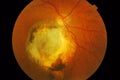 Medical Fundus photo of retinal patology