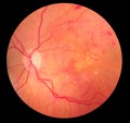 Medical Fundus photo of retinopathy hemorrhage Royalty Free Stock Photo
