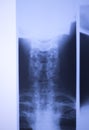 Medical xray spine neck scan Royalty Free Stock Photo