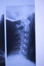 Medical xray spine neck scan Royalty Free Stock Photo