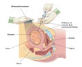 Medical Illustration Of Amniocentesis 