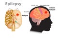 Medical illustration of a brain with epilepsy