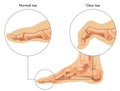 Medical Illustration Of Claw Toe Royalty Free Stock Photo