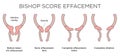 Medical illustration diagram - Bishop Score Effacement levels