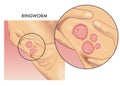 Ringworm infection