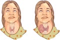 Medical illustration of goiter Royalty Free Stock Photo