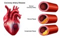 Medical illustration of Heart Coronary Artery Disease Royalty Free Stock Photo