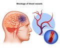 Medical illustration of Human Brain arteries blockage Royalty Free Stock Photo