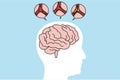 Medical illustration of human brain stroke