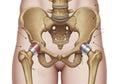 Human hip replacement illustration Royalty Free Stock Photo