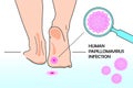 Medical illustration of an infection of the DNA virus - human papillomovirus. Feet on the floor and HPV virus model under a