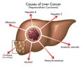 Medical Illustration Of Liver Cancer Causes Royalty Free Stock Photo