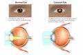 Medical illustration of a normal eye and an eye with a cataract, Royalty Free Stock Photo