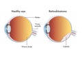 Medical illustration of retinoblastoma