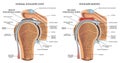 Medical illustration of shoulder bursitis