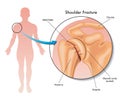 Medical Illustration Of Shoulder Fracture 