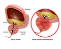 Medical illustration showing Benign prostatic hyperplasia BPH and Normal prostate. Prostate gland enlargement