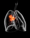 Lung cancer or carcinoma, medically illustration 3D on black background