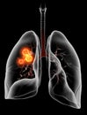 Lung cancer or carcinoma, medically illustration 3D on black background