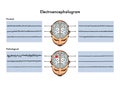 Electroencephalogram