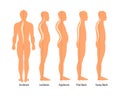 Medical illustration of spinal deformity types: scoliosis, lordosis and kyphosis, Sway back. Body posture defect