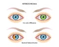 Heterochromia of the iris