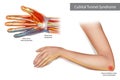 Medical illustration to explain Cubital tunnel syndrome. Ulnar nerve entrapment. Fascia involved in ulnar nerve Royalty Free Stock Photo