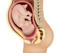 Medical illustration of the Total placenta previa. Complete previa